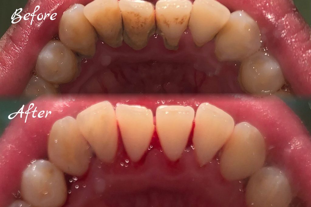 Scaling and Air Polishing — existing MiCasa Dental clinic image.