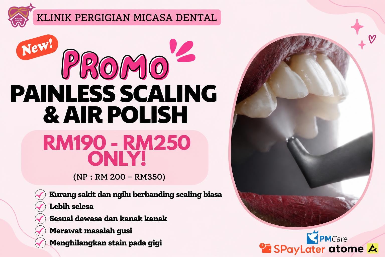 Promosi Painless Scaling dan Air Polishing MiCasa Dental
