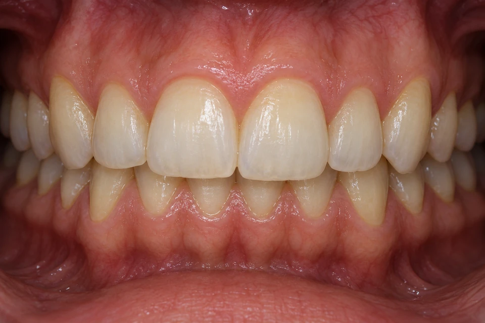 Ilustrasi intraoral: Gigitan dalam