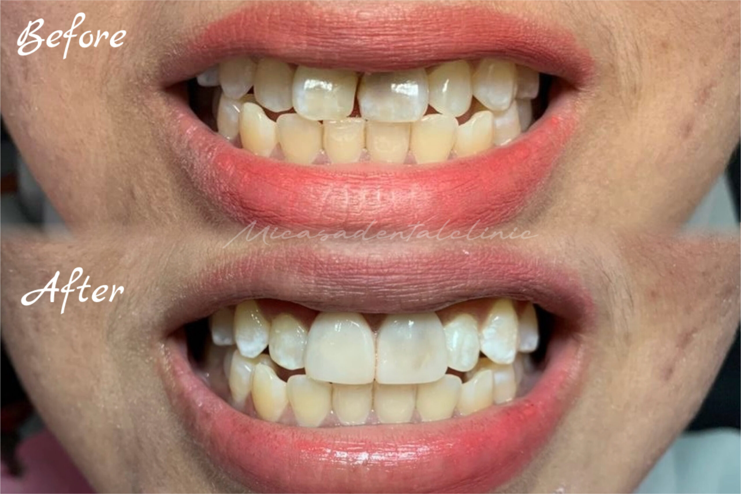 Sebelum dan selepas rawatan veneer di MiCasa Dental